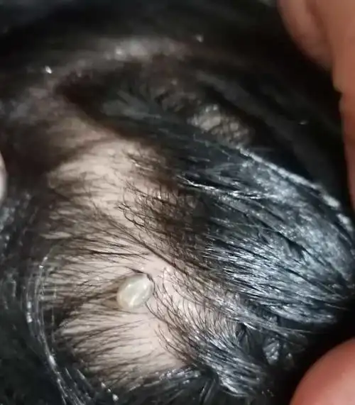 罗田山林里游玩,晚上洗澡时,妈妈黄女士发现她的后腰上冒出一个小黑点