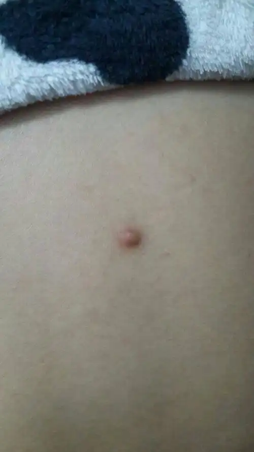 曾经长过,在右下腹,用手触及,感觉有坚硬的颗粒,不