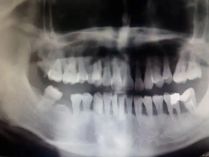 69 口腔医学专业讨论版 69 ---------今天去拍了牙片,感觉人生