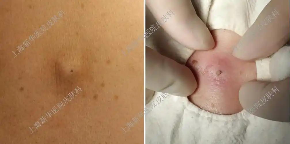 "粉瘤"是什么?该怎么治?总能挤出白色牙膏样东西.