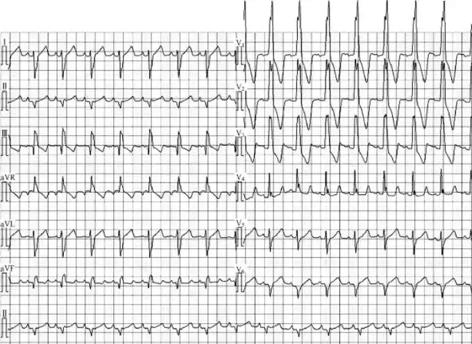右心室肥大的家庭救治方法_挂云帆