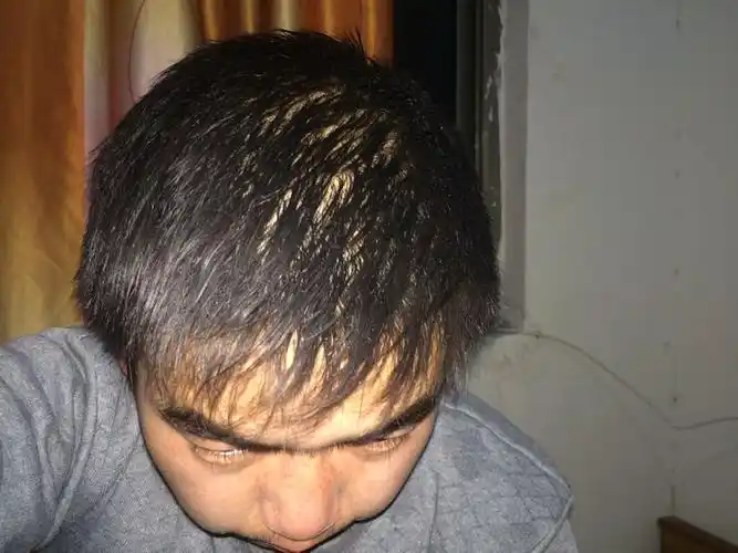 男26岁 我这头发正常么,有点稀疏,几年以前头发还挺粗,近几年越来越细