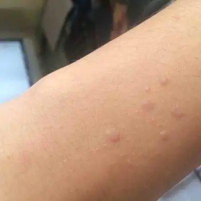 腋窝疣怎么治疗