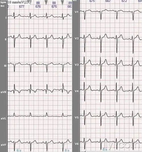 假性电轴左偏心电图