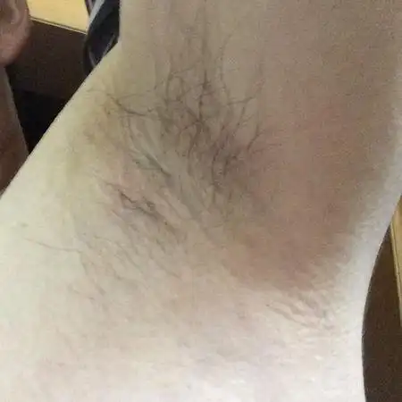 腋下长包了,今天才发现,这是怎么了啊?男,25岁.就是照片上有一点点红