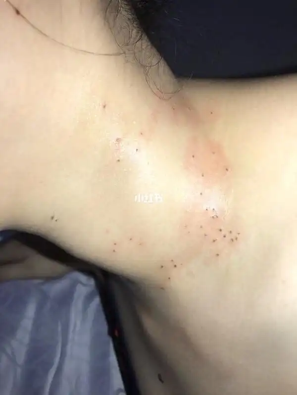 脖子上长了好多丝状疣7515不打针不吃药7515我只用了115