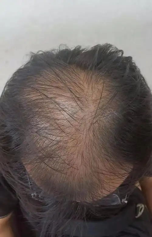 头皮营养液真的能让秃顶重新长出头发吗?