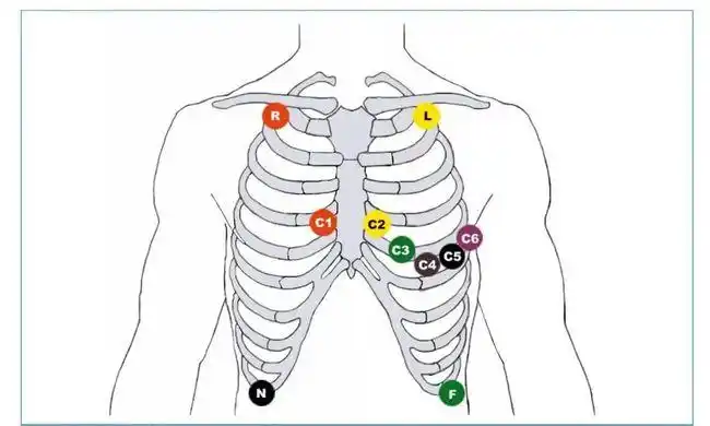 这种躯干位置的肢体导联有时也用于婴幼儿心电记录,以减少由上下肢体