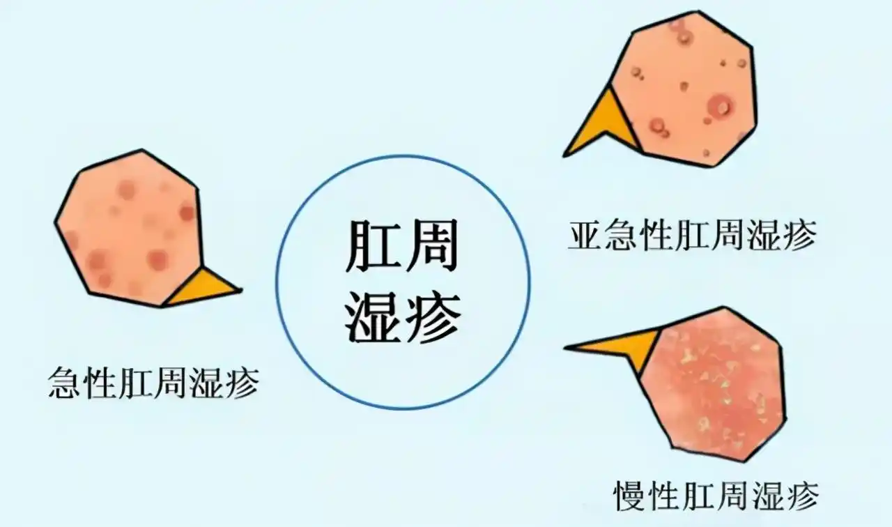 肛周瘙痒是癌细胞在作祟吗?医生:想要肛周健康,少做这2类事