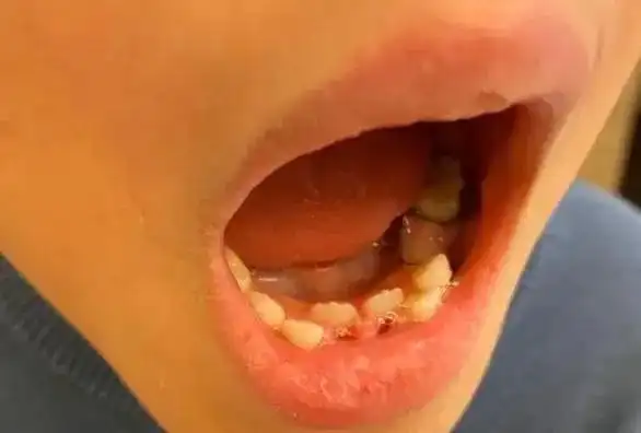 是小问题,相应治疗技术已经很成熟,不耽误孩子长成一口洁白整齐的牙齿