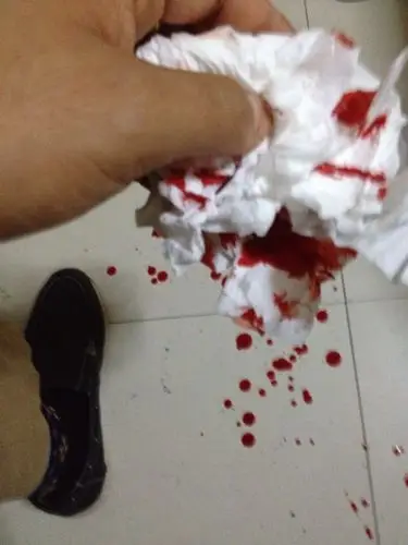 手指被刀片割伤需要打破伤风吗?流了不少血