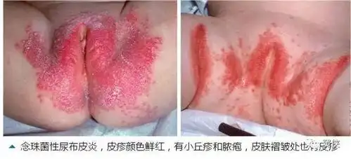 3 过敏性尿布皮炎   这是对尿布本身产生的过敏性接触性皮炎,这种情况