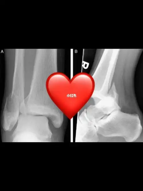 患者三踝骨折有错位