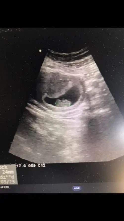 二宝现在11周多 感觉孕囊和宝宝形状都不一样耶 哈哈