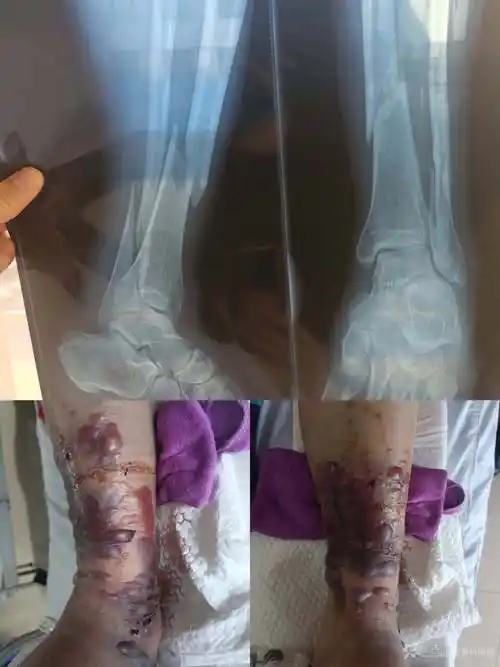 一例胫腓骨骨折