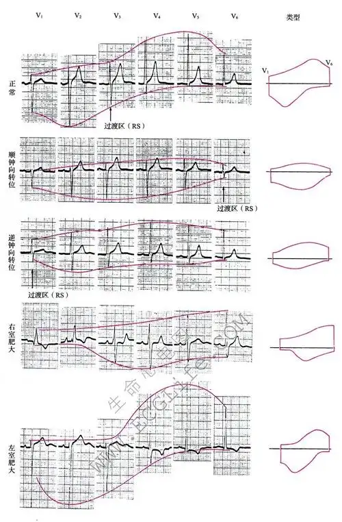 右心室肥大心电图表现