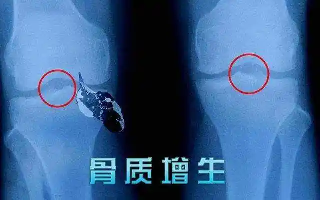 膝关节骨刺疼痛怎么办老年人膝盖长了骨刺怎么治疗健康百科