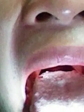 舌头根部有五六个红的圆 点是什么病