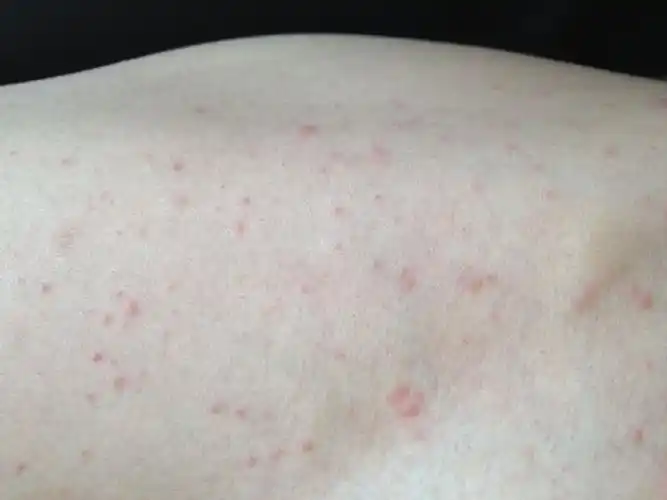 不慎接触艾滋病毒有72小时自救, 艾滋病初期症状 – 66分享网