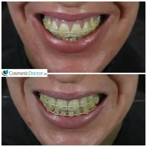 gummy smile treatment with botox