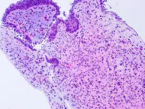 尿路纤维上皮息肉