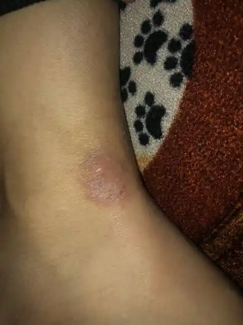 玫瑰糠疹好转的迹象图片