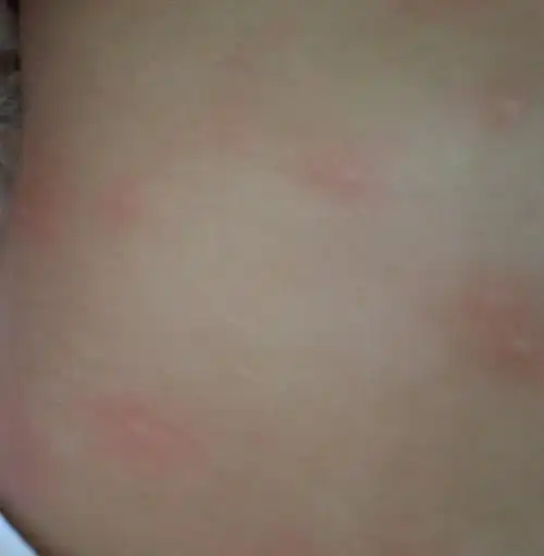 我家宝宝6个半月了,背上起了好多红疙瘩带白头,不发烧.