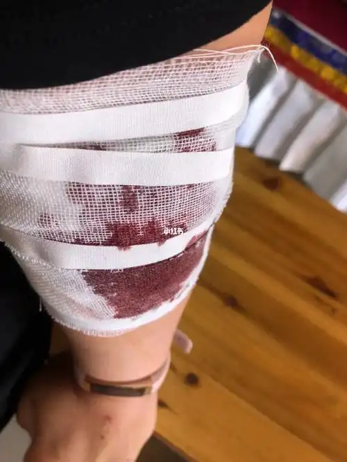 左半边全是淤青和伤口去疤的活血化瘀的多多推荐也可私信 感恩的心