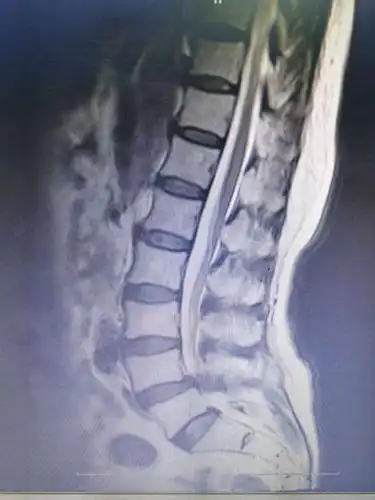 37床,要腰4/5椎间盘突出症