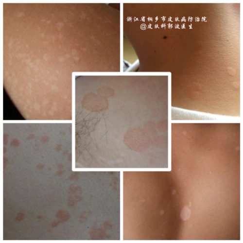 花斑癣_疾病介绍_治疗方法_介绍_治疗方式 - 好大夫在线