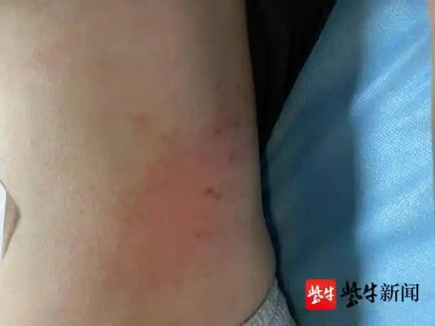 刘先生被蜈蚣咬伤