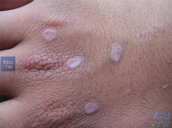 【附图】 扁平疣(verruca plana)症状表现 _皮肤病诊断图谱 | 天山医
