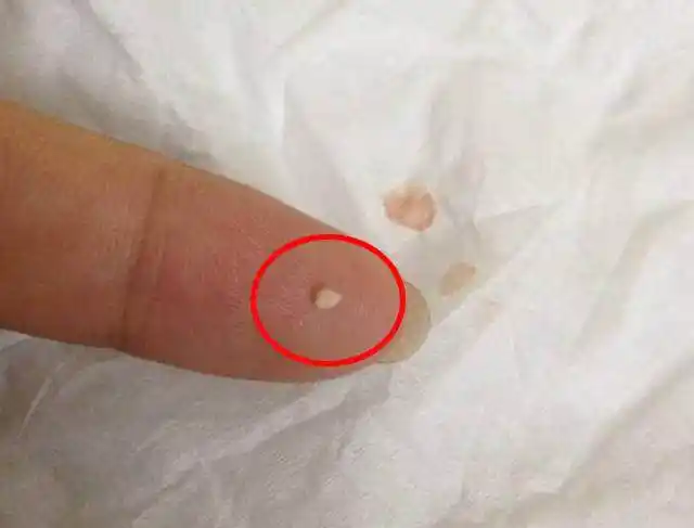 女人脸上有螨虫不要怕,药店2块钱粉末轻松除螨,避免坑坑洼洼