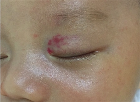 新生儿血管瘤多久开始消退