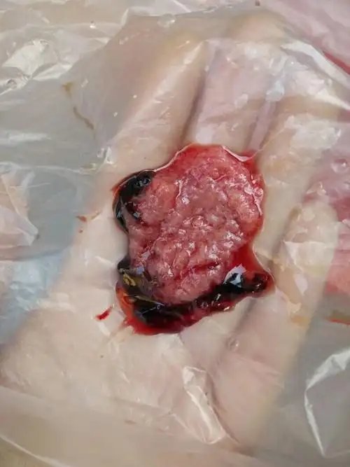 药流孕囊图片40天女孩