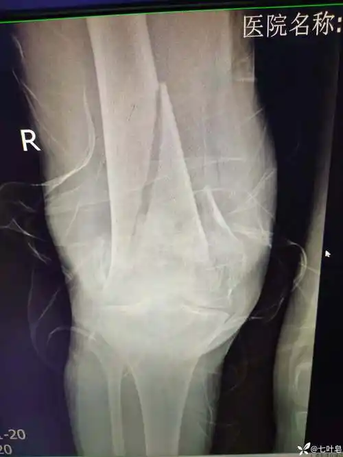 老年股骨髁上髁间骨折分享