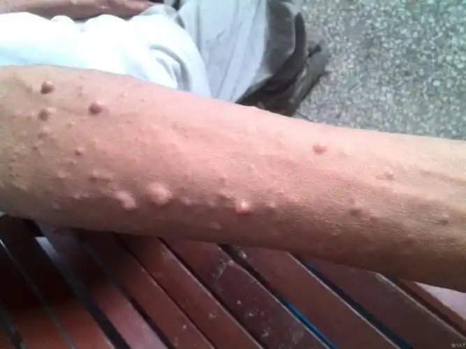 神经纤维瘤病1型的临床表现1)牛奶咖啡斑:几乎所有的患者都有皮肤色素