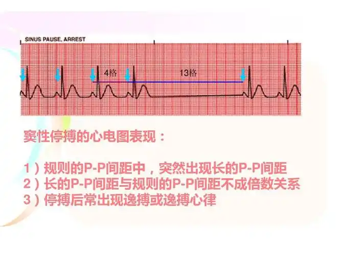 窦房传导阻滞课件ppt