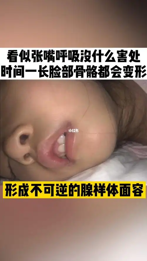 张嘴呼吸看着正常,时间久了脸就变形了_腺样体肥大_母婴_育儿经验