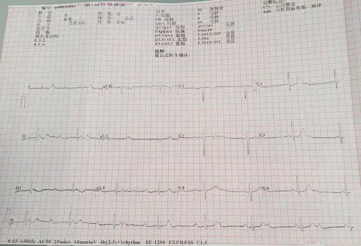 二度一型房室传导阻滞
