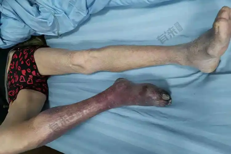 女性脉管炎的症状图片_有来医生