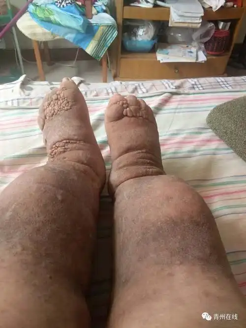 双下肢肿的像两根大象腿,俗称象皮腿,也叫淋巴障碍形成的象皮腿