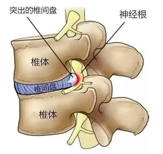 你好,颈椎病系列科普(一):哪些症状说明你得了颈椎病_颈椎病_疾病介绍