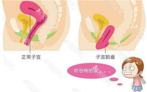 原理是先将下坠子宫推回到原位,然后从宫颈处开始由里往外开始褶皱式