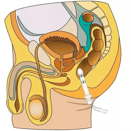 耻骨上,阴茎,龟头口部,阴囊,腹股沟,小腹,睾丸,膀胱,腰骶部疼痛,胀