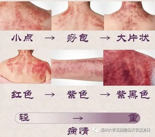 医者仁心为患者 中医刮痧显奇效