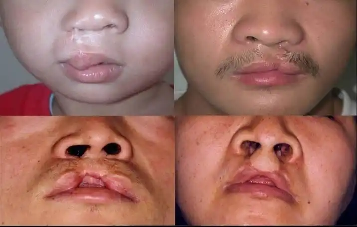 患有唇裂/唇腭裂的孩子一般在1岁以内做手术进行矫正,否则孩子很难