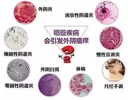 妇科炎症之"最",你重视了吗?_女性