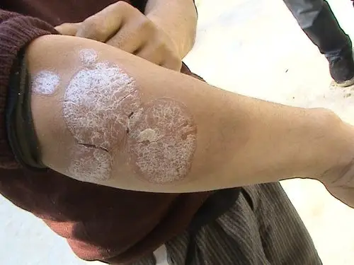 牛皮癣图片牛皮癣的病因