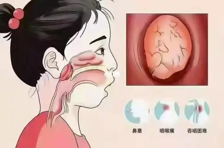 腺样体肥大局部症状自查